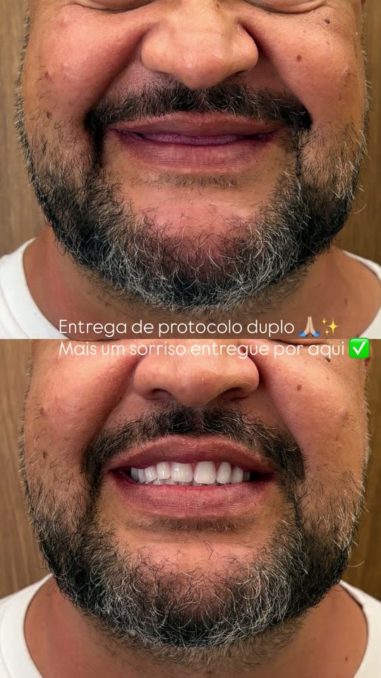 dentista volta redonda odontomv resultado de implante dentário