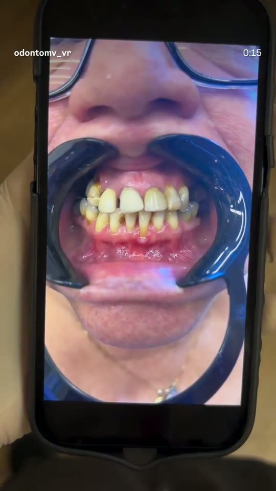 paciente satisfeito após implante dentário volta redonda odontomv